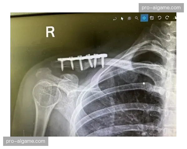 拉齐奥中场罗韦拉成功接受锁骨骨折手术,开启术后康复程序 拉齐奥中场罗韦拉成功接受锁骨骨折手术,开启术后康复程序